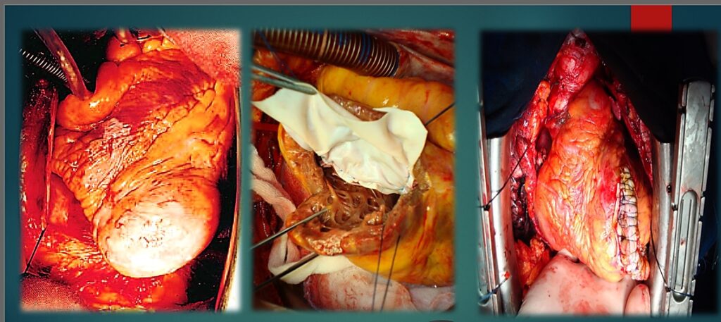 علاج أمراض صمامات القلب